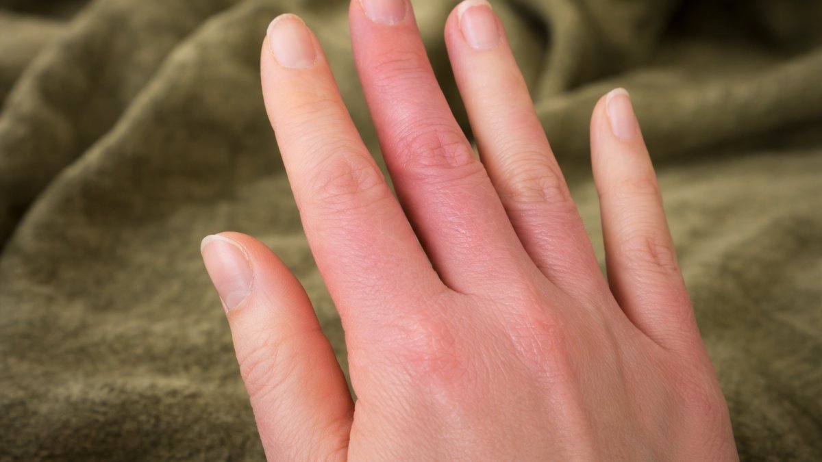 Parmaklardaki mavi-mor renk değişimine dikkat: "Raynaud Fenomeni" habercisi olabilir! Peki nedir bu "Raynaud Fenomeni?"