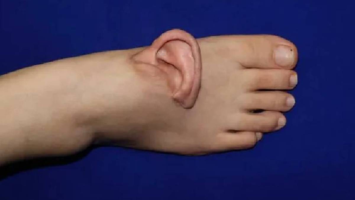 Tıpta ezber bozan yöntem: Kulak geçici olarak ayağa nakledildi