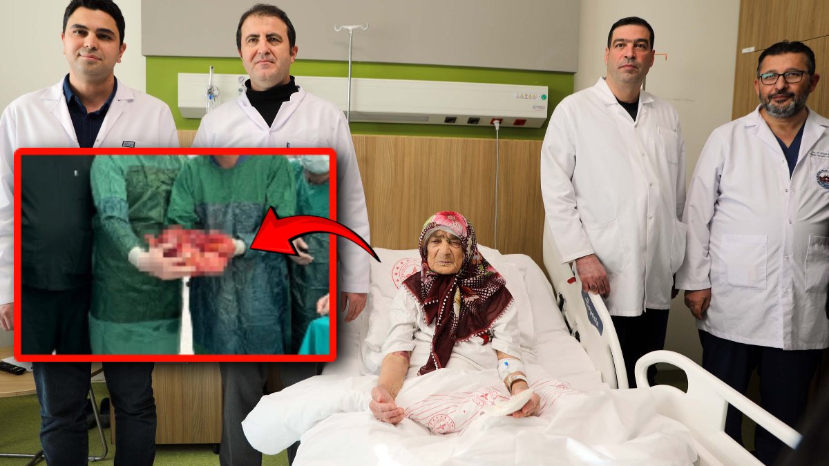 Tıp dünyasını şaşırtan operasyon! 87 yaşındaki hastadan 4,5 kiloluk kitle çıkarıldı