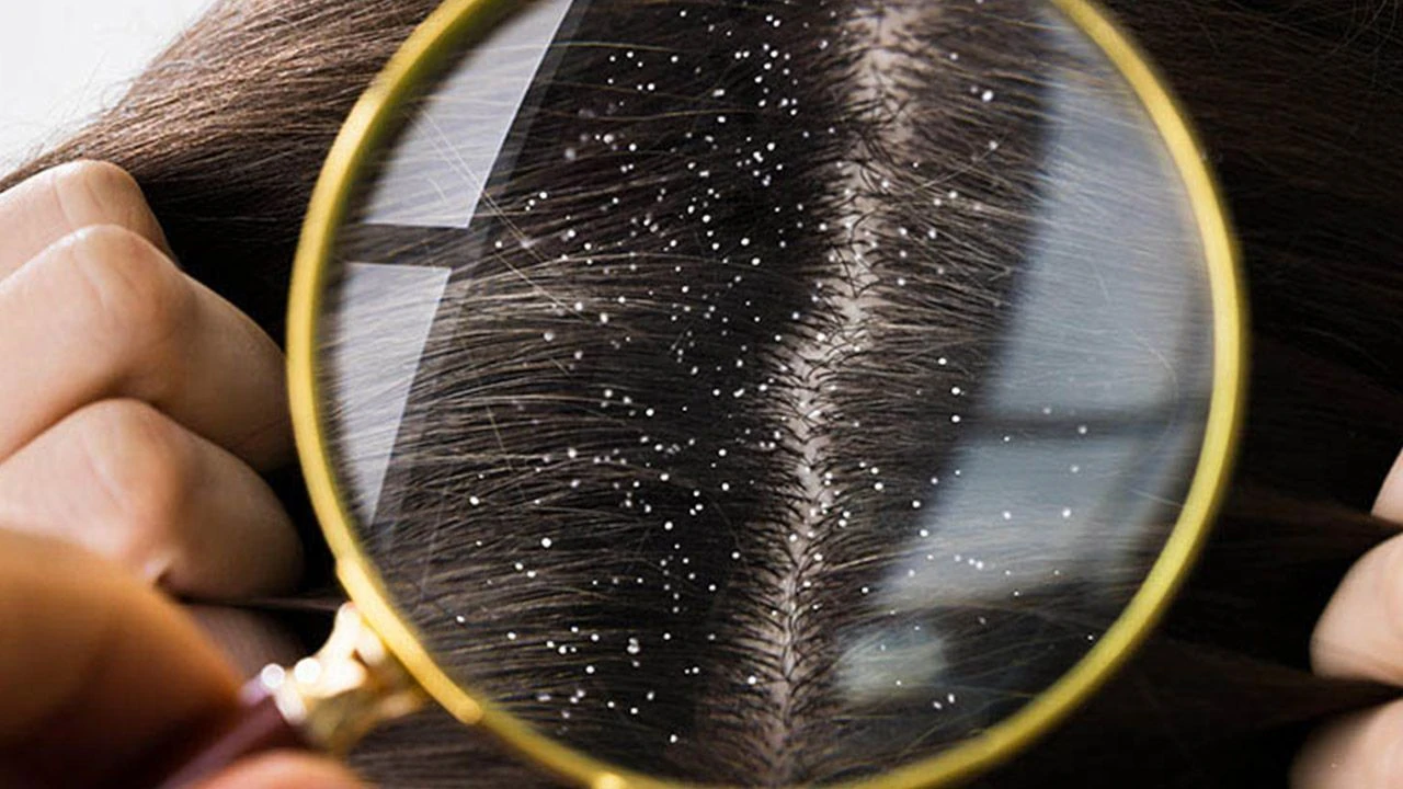 Saç derinizdeki kaşıntı ve beyaz pullara son: Sadece 20 dakikada etkisini gösteriyor