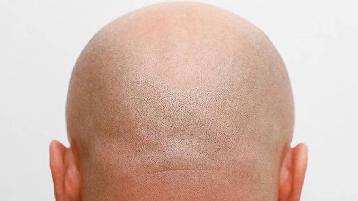 Kellik tarih olabilir: Geleneksel bitki saç dökülmesini yavaşlatıyor