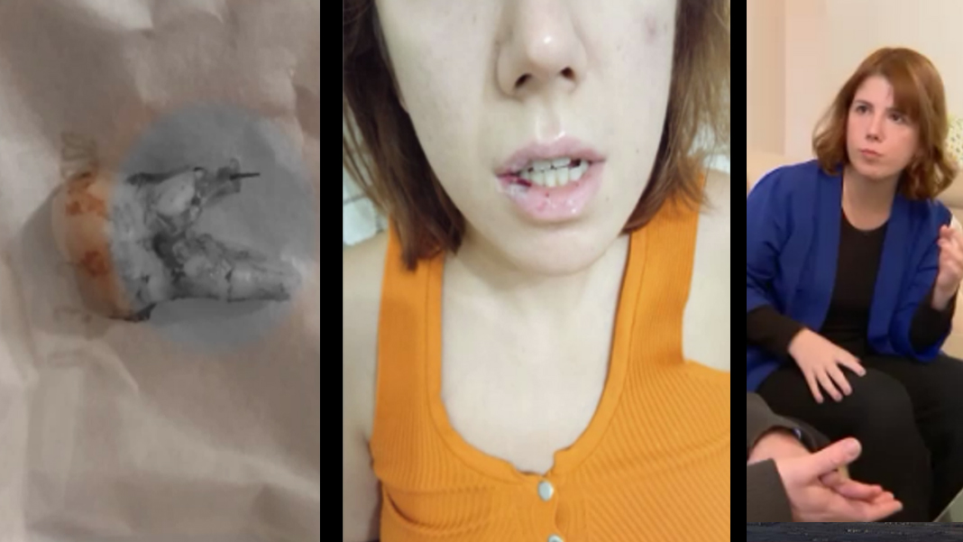 Diş ağrısıyla gitti, hayatı kabusa döndü: 29 yaşındaki genç kadın iki yıldır mama ile besleniyor