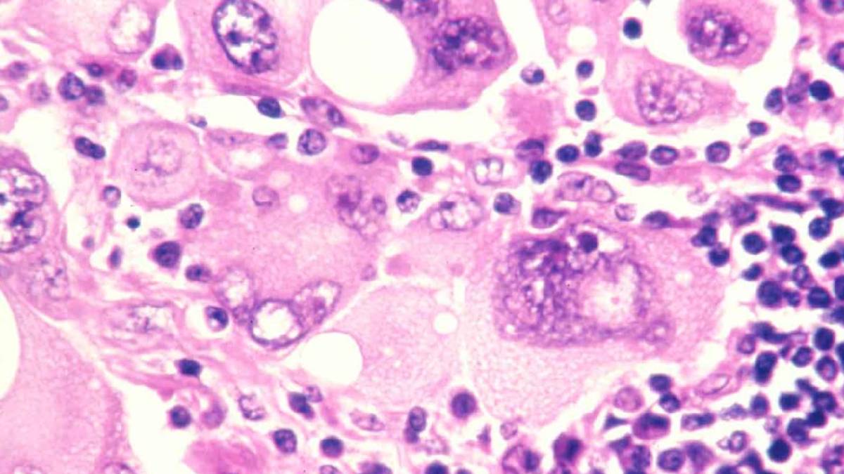 Cilt kanserinin büyümesini hızlandıran molekül ortaya çıkarıldı