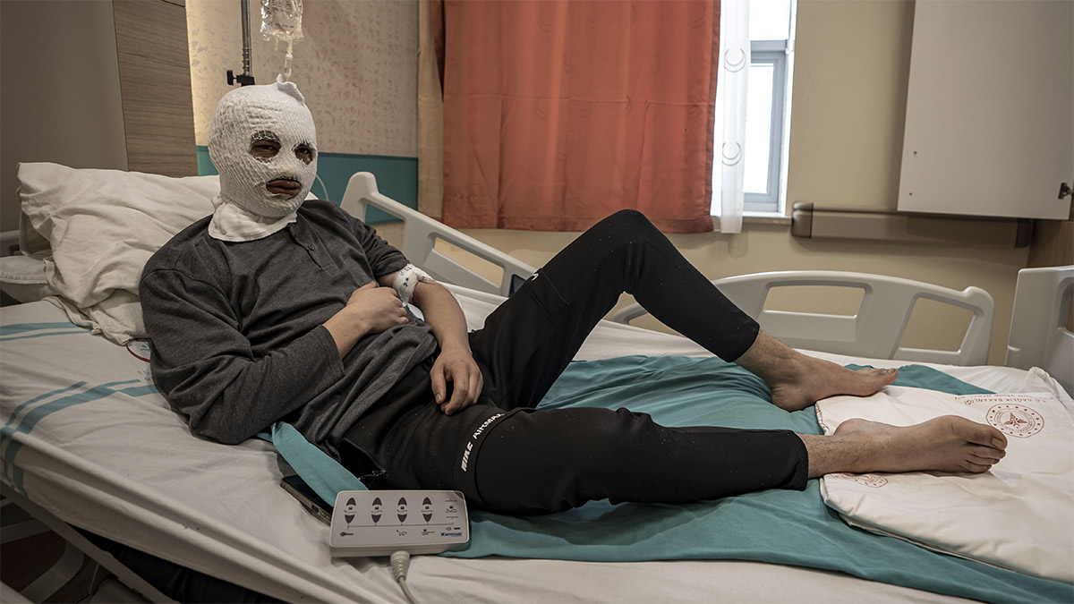 Çakmak gazı tüpü elinde patladı: 19 yaşındaki genç ağır yaralandı