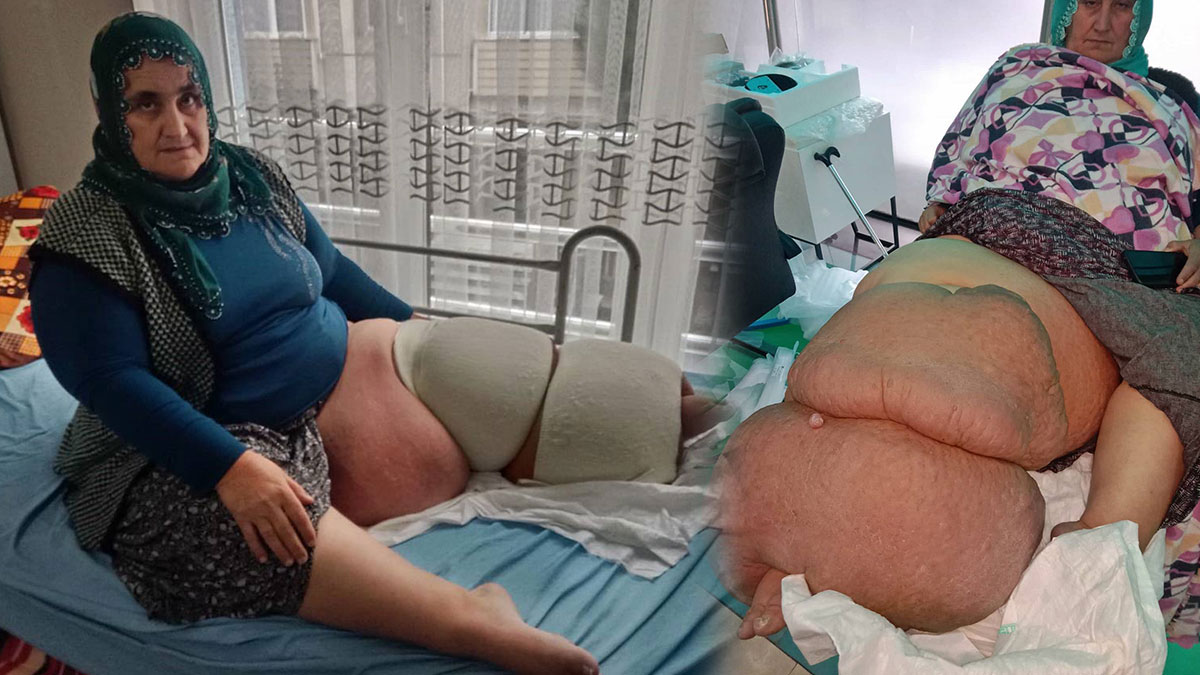 Bacağından bir insan ağırlığı kadar yük attı ama hastalığı bitmedi