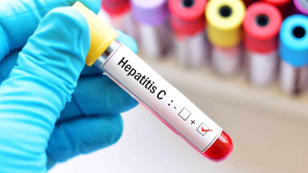 Uzmanlardan Hepatit C uyarısı: Yıllarca sessiz, sonu kanser olabiliyor