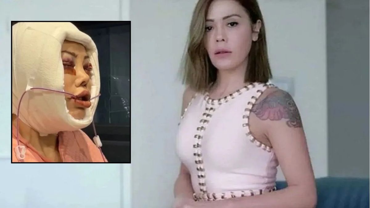 Yüz nakli operasyonları gündem olmuştu: Didem Ceran’dan kötü haber!