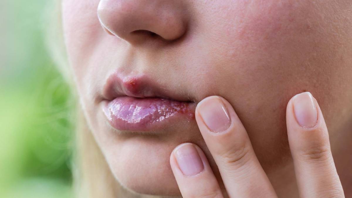 Dudakta uçuk neden çıkar? Tetikleyici faktörlere çok şaşıracaksınız