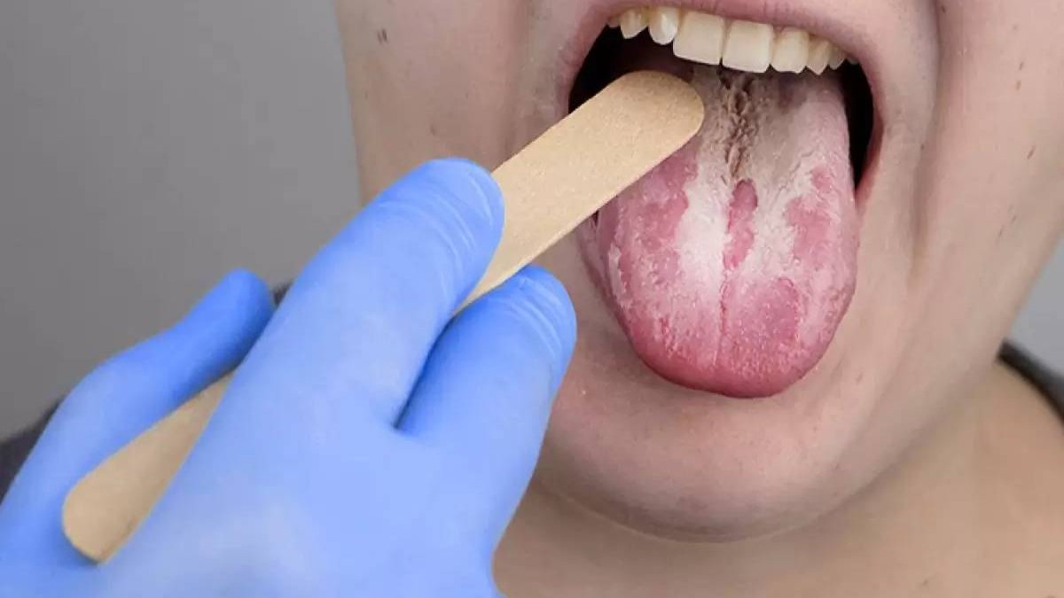 Diş fırçalamak yeterli olmuyor: Ağız mantarını geçiren doğal destekler