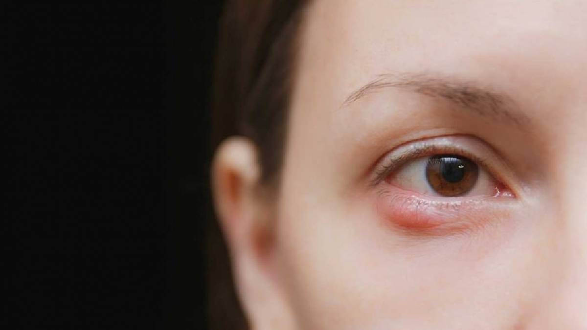 Arpacık nedir, niçin oluşur?