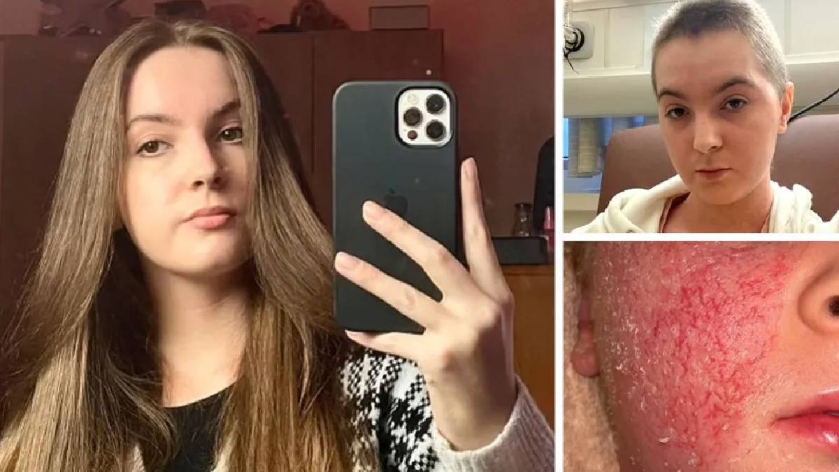 "Derimiz dökülüyor ve kimse bize inanmıyor": Şifa diye sürülen kremlerin yarattığı gizemli kâbus