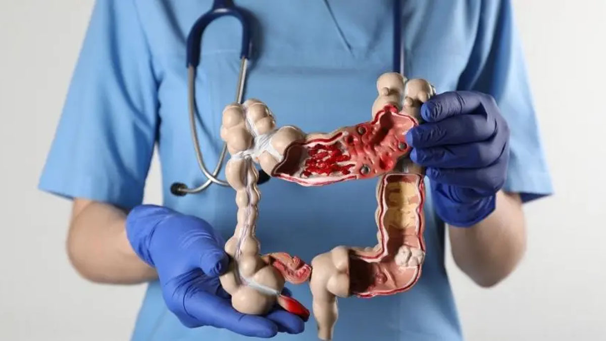 Obezite sadece kilo değil, kanser sebebi: Uzman isimden 'kolon kanseri' uyarısı ve 6 sinsi belirti