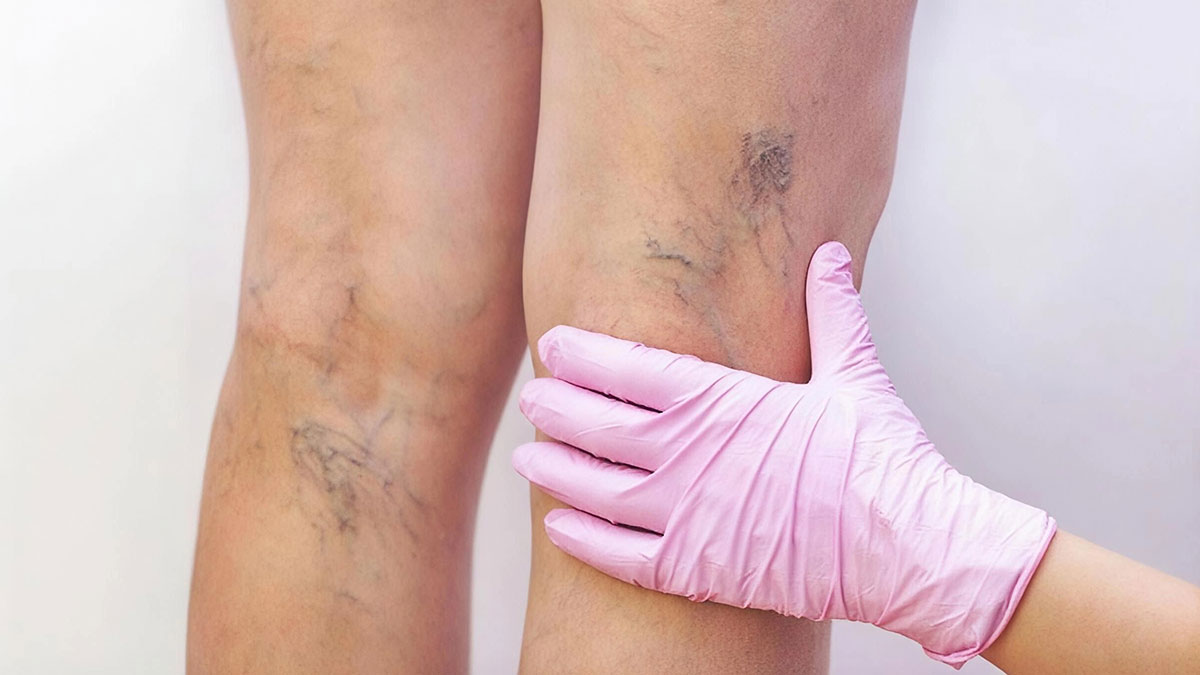 Her üç yetişkinden biri muzdarip: Toplardamarlar görevini yapamıyor