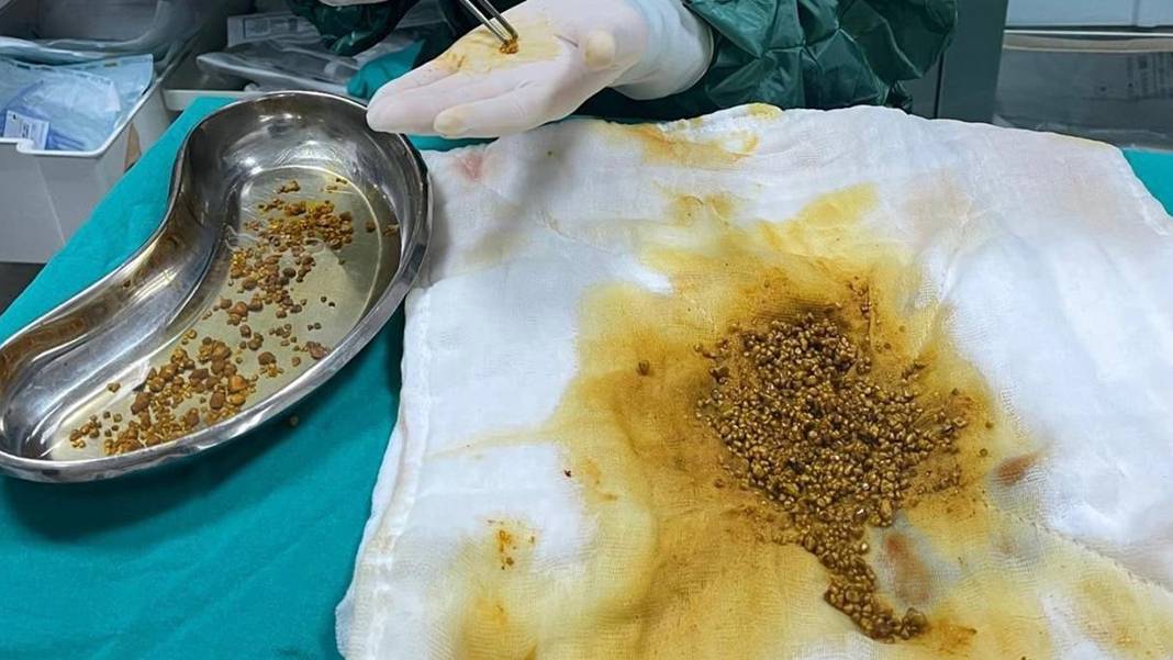 Bingöl'de tıp dünyasını şaşırtan ameliyat: Safra kesesinden tam 2 bin 67 taş çıkarıldı