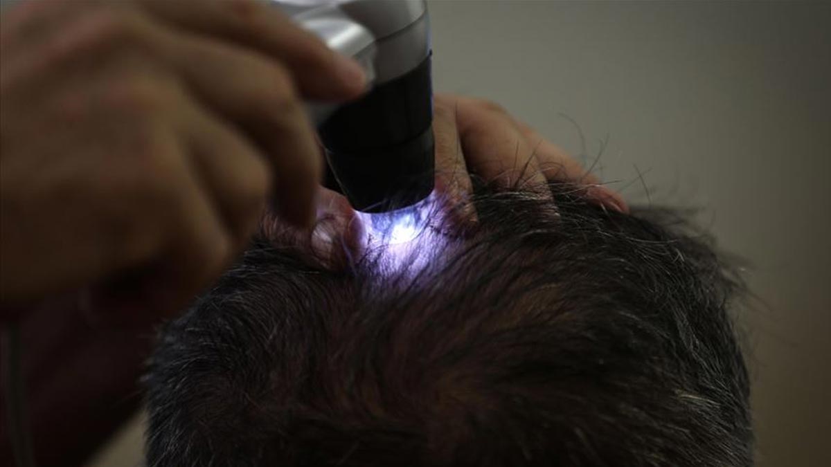 New York Times yazdı: Erkeklerin yeni takıntısı 'kellik ilacı' ve yan etki çıkmazı