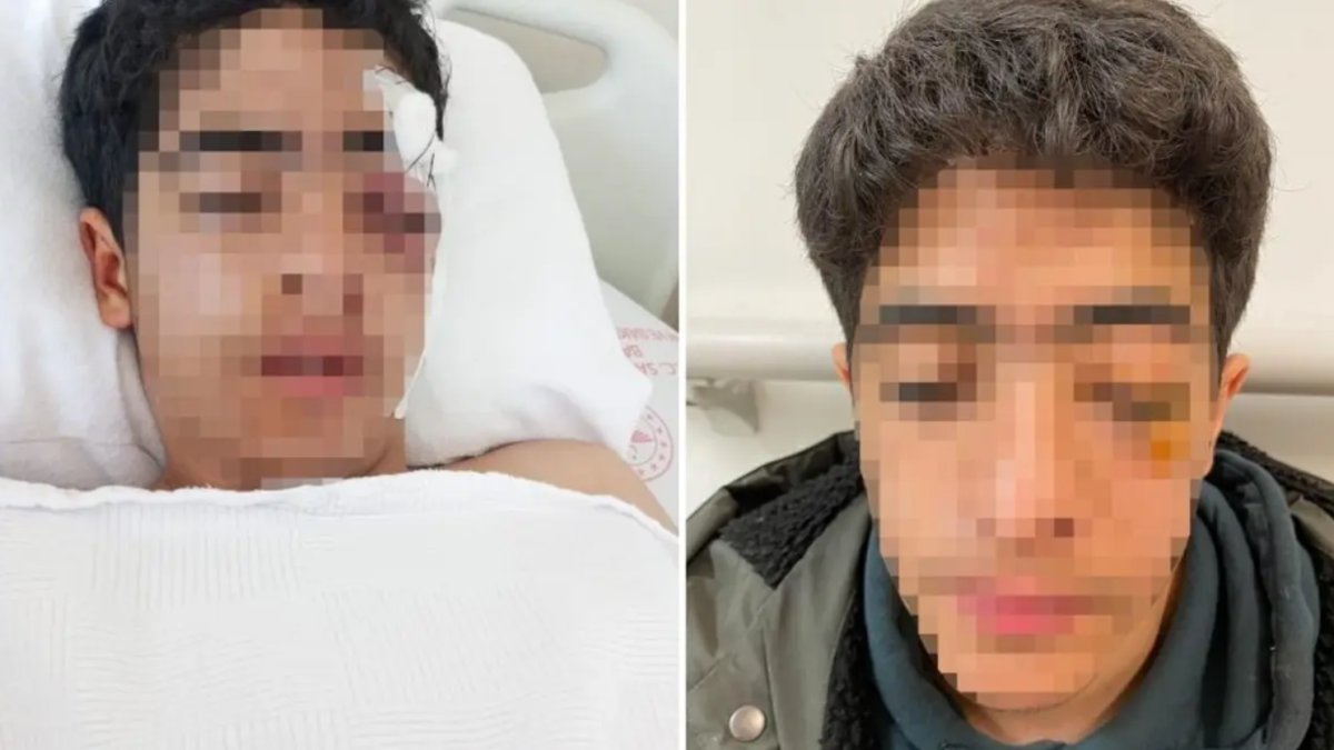 15 yaşındaki çocuğa akranından muştalı saldırı: Vücudunda çok sayıda kırık var