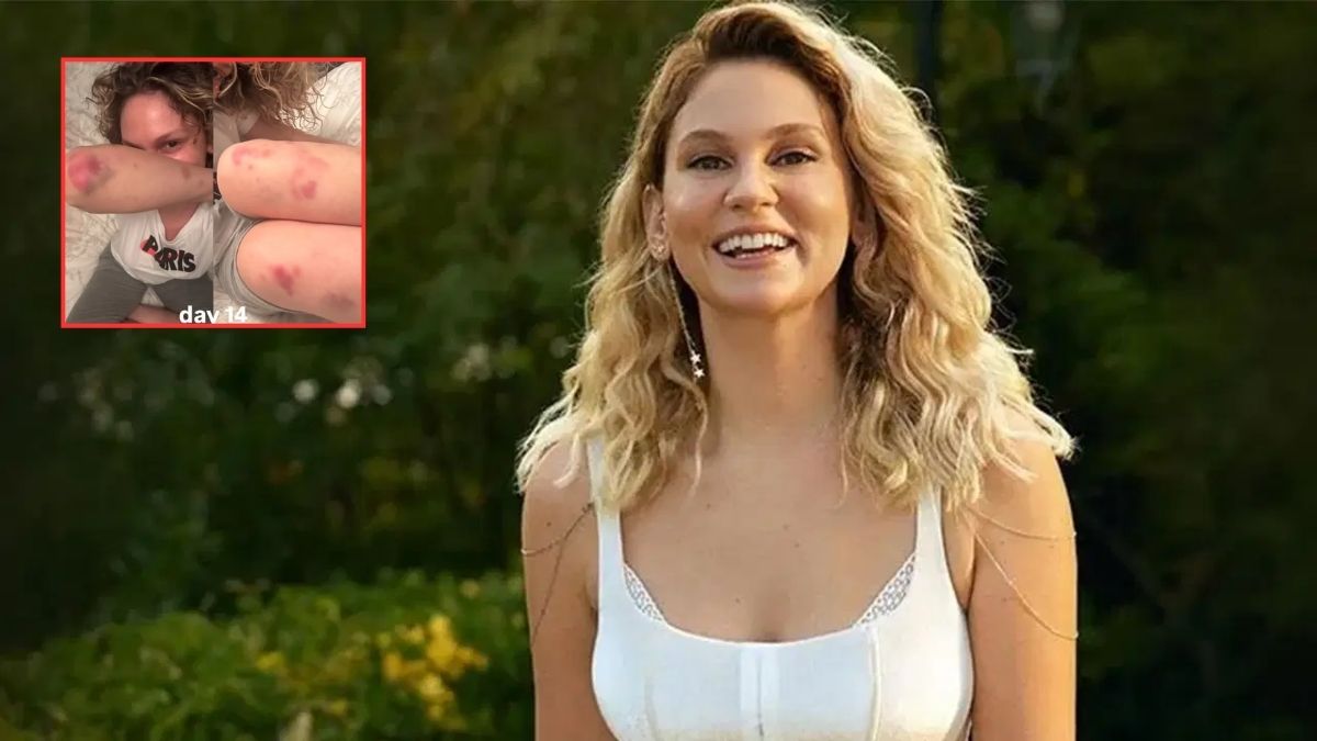 Vücudundaki morluk ve kızarıklıklar korkuttu! Farah Zeynep Abdullah son halini paylaştı