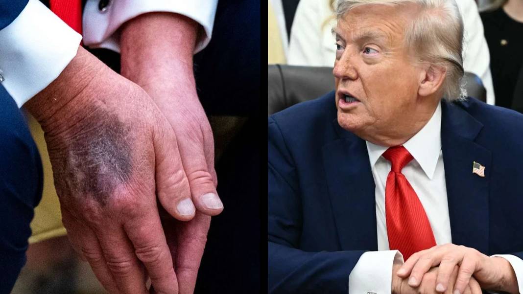 Trump’ın 'mükemmel' sağlık raporu tartışma yarattı: Ellerindeki morluklara cevap yok