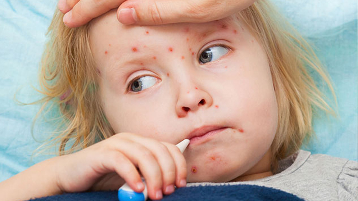 Çocuklarda kızamık ve suçiçeği belirtileri nelerdir? Dr. Pelin Aytaç Uras anlattı