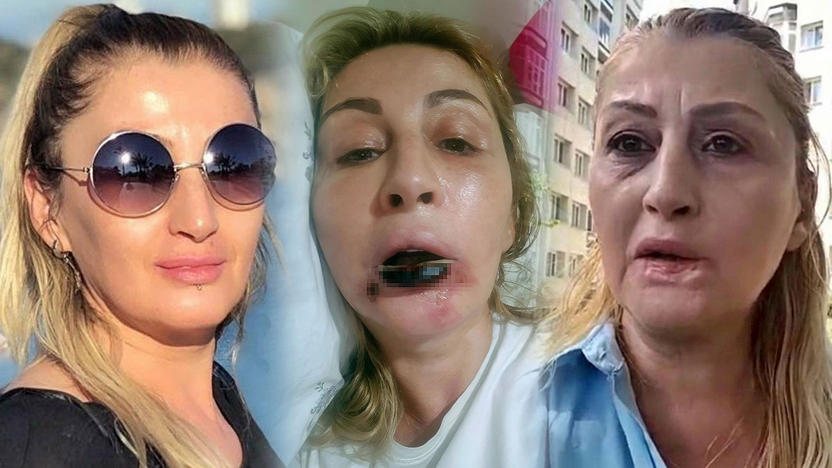 Yanlış dolgu yüzünden alt dudağı tamamen çürüdü