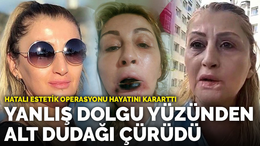 Estetik Operasyon Sonrası Dudak Kaybı Yaşayan Kadın Tazminat Kazandı