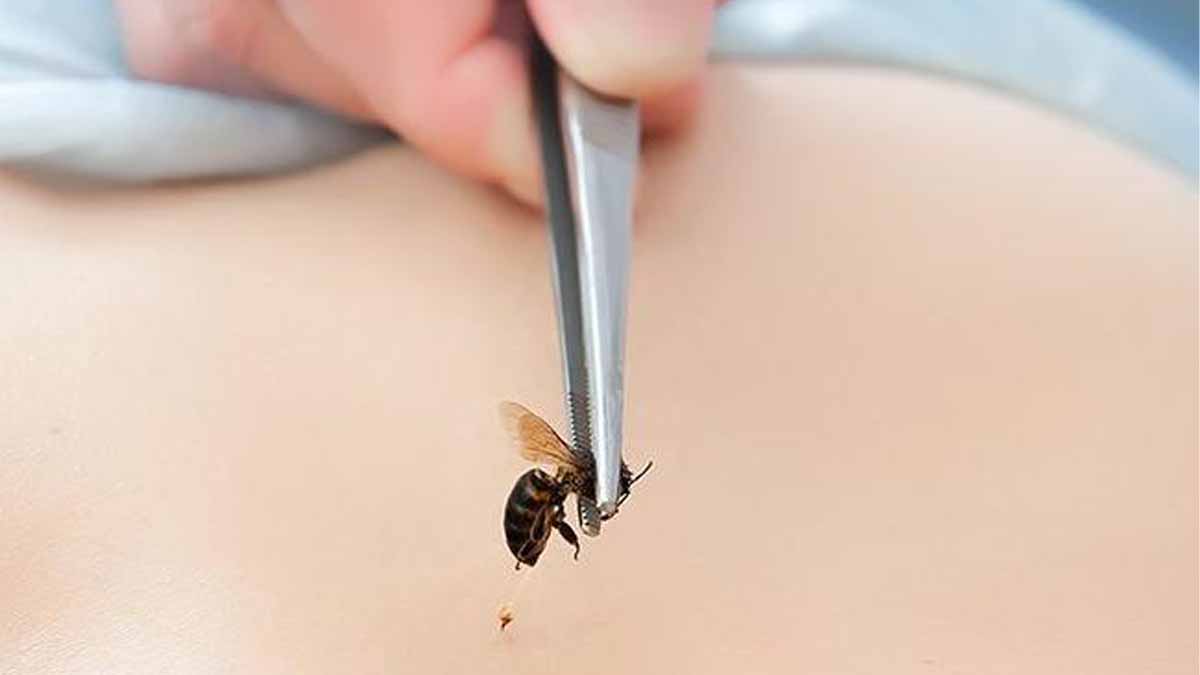 Kalp krizi sanılıyor ama sebep arı alerjisi! Doç. Dr. Senanur Işık’tan hayati uyarılar