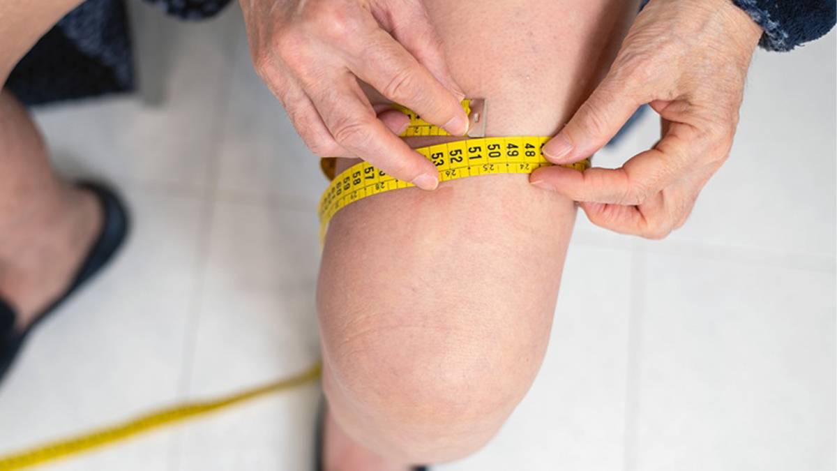"Kilo veriyorum ama bacaklarım incelmiyor" diyorsanız dikkat! Obezite değil lipödem olabilir