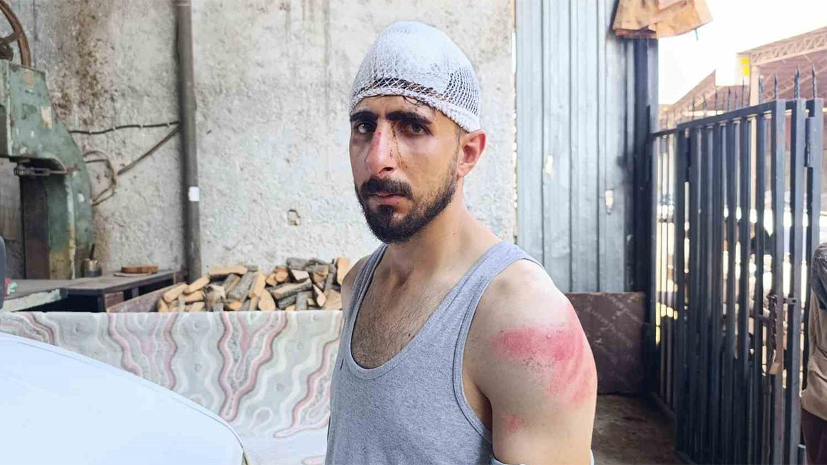 "Yavaş gidiyorsun" diyerek önünü kestiler: Burnu kırıldı, başına 8 dikiş atıldı