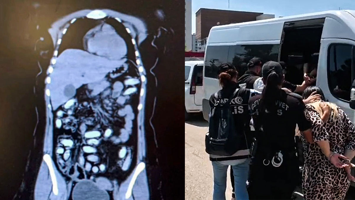 Adana'da akılalmaz olay! Midelerinden 140 kapsül metamfetamin çıkan 2 kadın tutuklandı