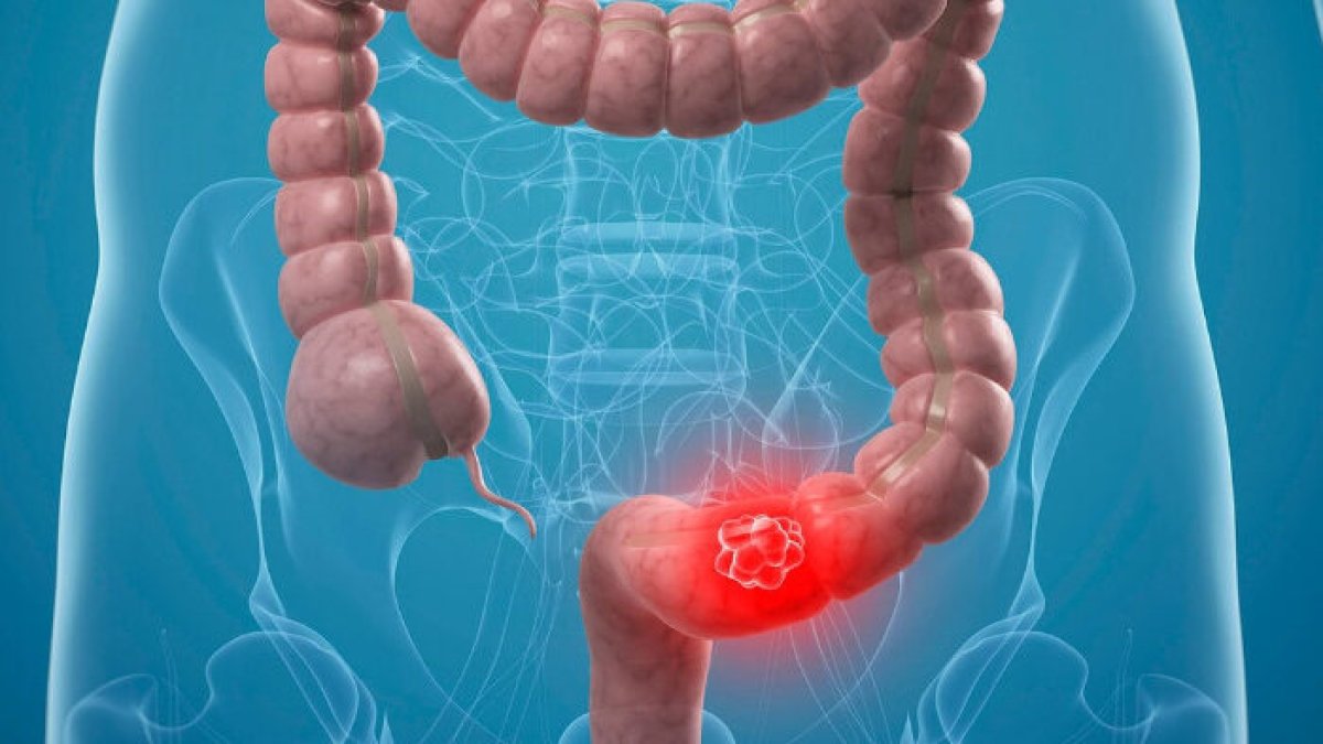 Herkes 'genetik' sanıyor ama yüzde 90'ının sebebi bambaşka: Kolon kanserini tetikleyen sinsi eksiklik