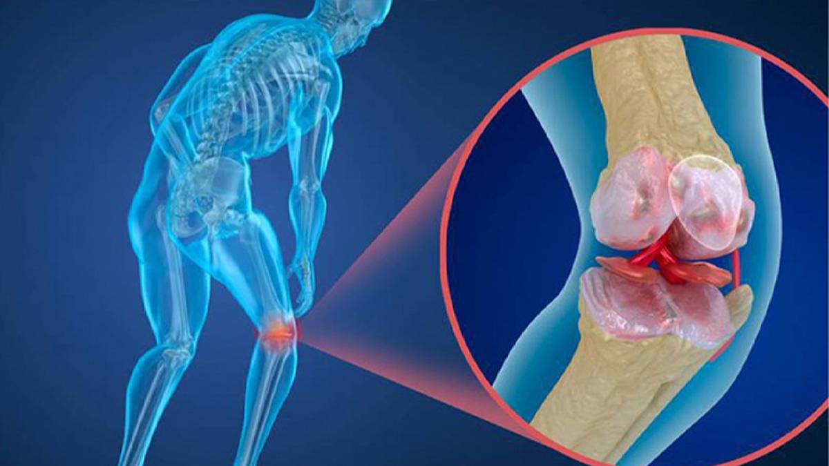 Kemik erimesi sakatlığa yol açabilir: 30 yaşından sonra bu belirtileri ihmal etmeyin!
