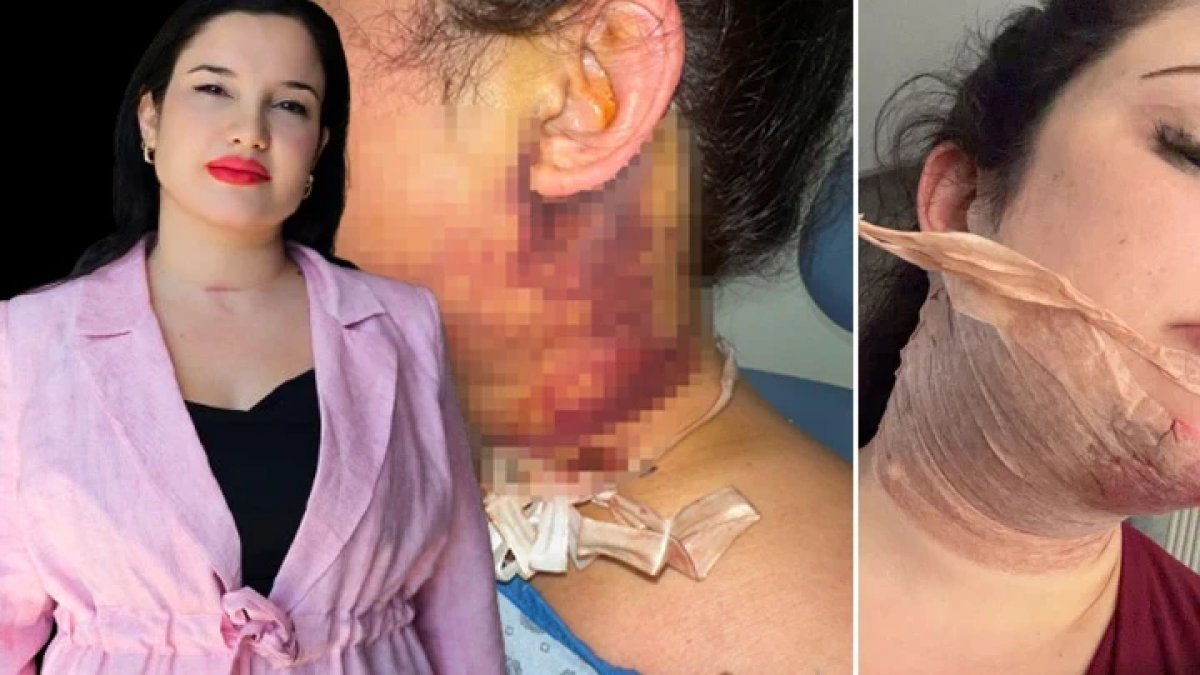 Estetik operasyonu kabusa döndü, 2 gün entübe edildi: Doktora milyon liralık dava açtı