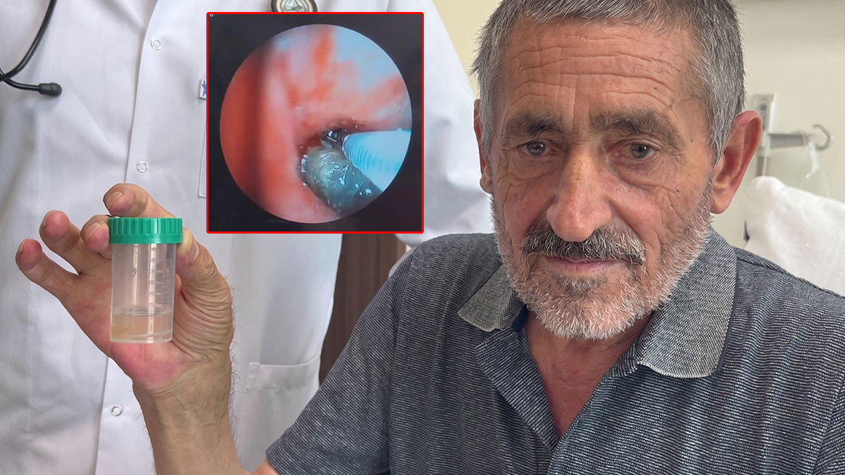 Ciğerinde kitle var sanıp ameliyat masasına yattı: Soluk borusundan çıkan cisim 'pes' dedirtti
