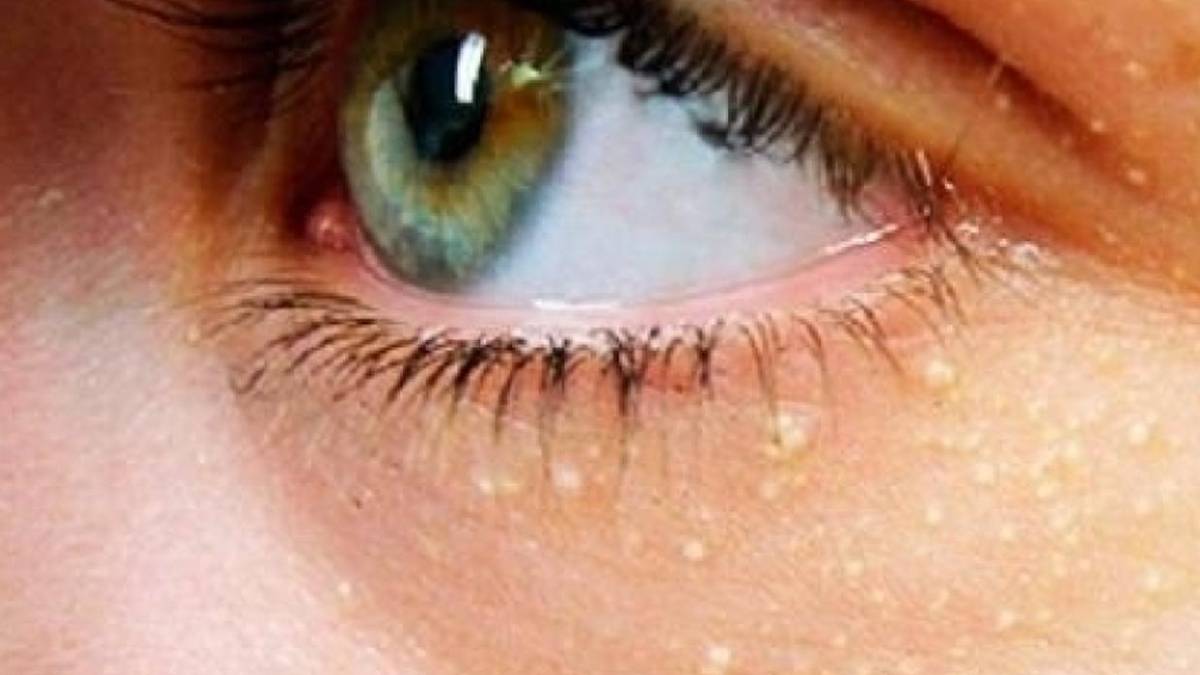 Göz çevresindeki sarı lekelere dikkat!: Kalp krizi ve inme riskini artırabilir