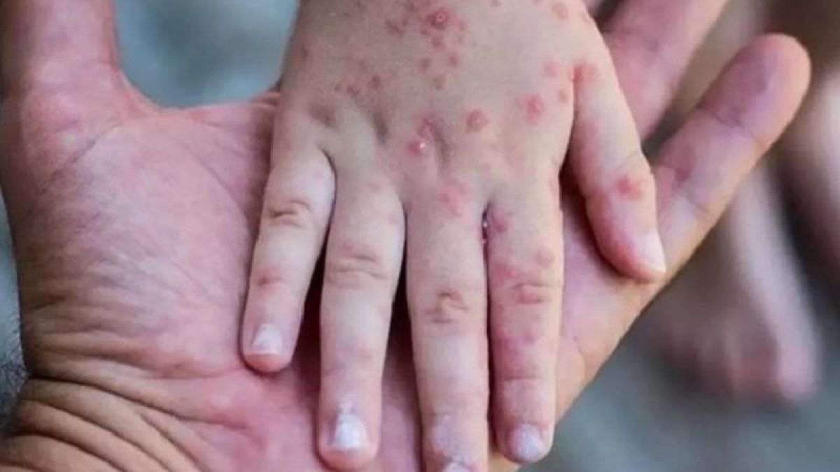Güney Afrika’da M çiçeği vakalarında artış: Son beş haftada 13 yeni vaka tespit edildi