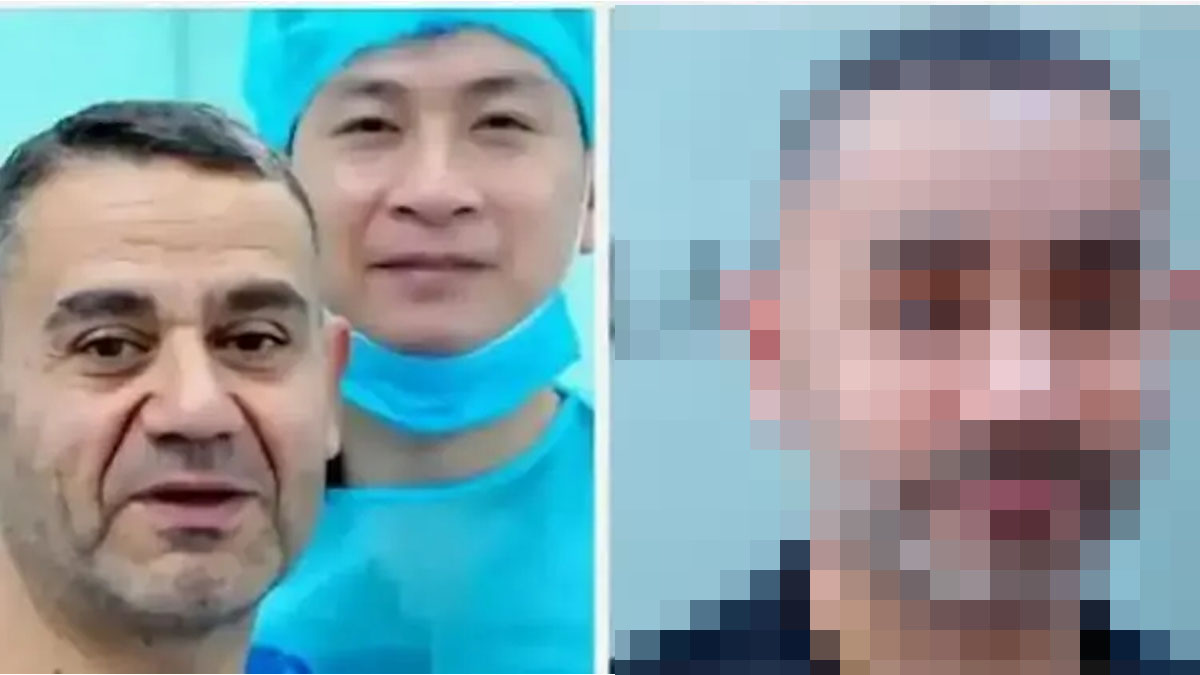 Gençleşmek için Vietnam'a gitti, yüzü tanınmaz hale geldi: Türk hekimlerden sert tepki!