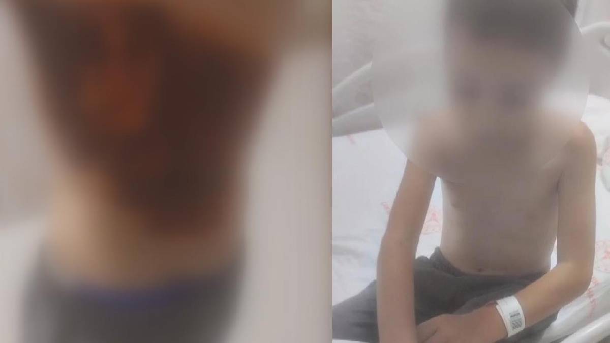 İstanbul'da korkunç olay: 12 yaşındaki çocuğun sırtına kolonya döküp ateşe verdiler