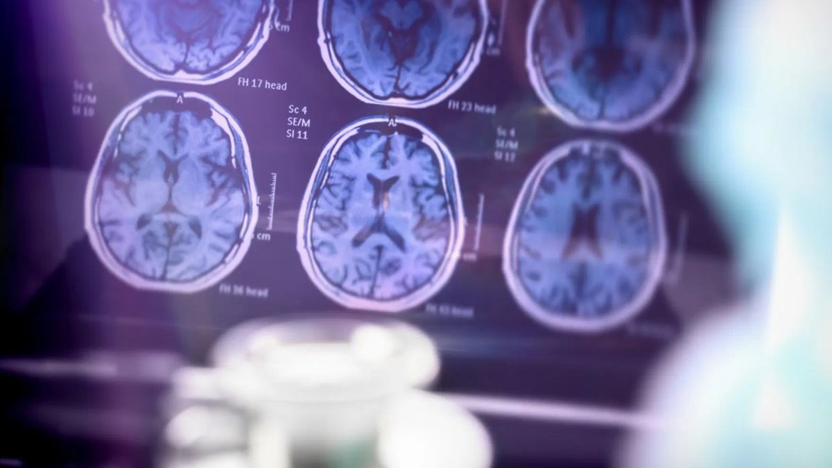 Alzheimer tedavisinde umut veren gelişme: Ameliyatsız 10 dakikada tedavi