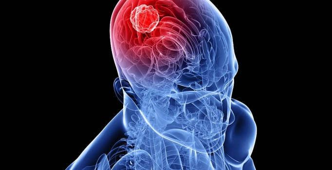 Tümör boyası beyin kanserinin çözümü mü?