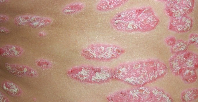 Sedefe karşı reçeteye yoga yazılıyor