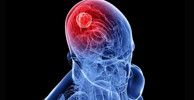 Uzmanlar açıkladı, baş dönmeleriniz beyin tümörü belirtisi olabilir