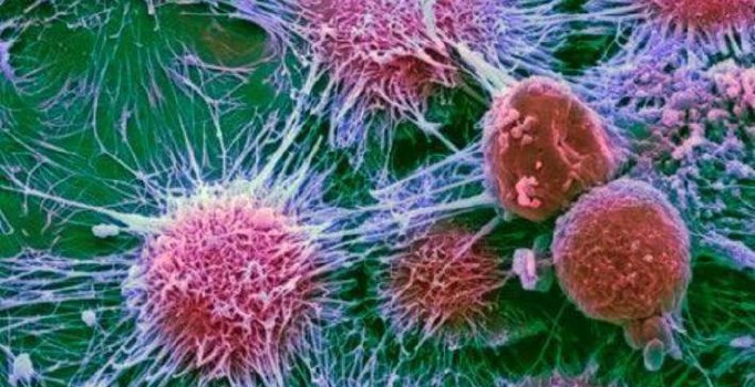 Cilt kanserinin akciğere yayılması yüzde 75 engellendi