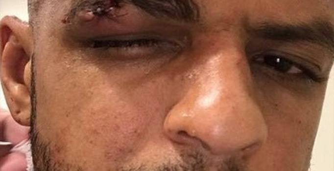 Felipe Melo'nun Corinthians-Palmeiras maçında kaşı açıldı