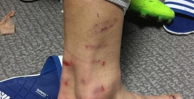 Volkan Şen'in darbe alan ayağını sosyal medyadan paylaştı