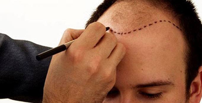 Saç ekimi nasıl yapılır? Saç ekiminde neler dikkat edilir? İşte 11 önemli madde