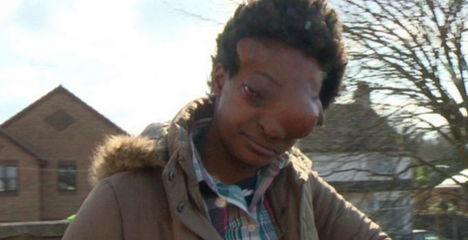 Kanser yüzünü bu hale getirdi!