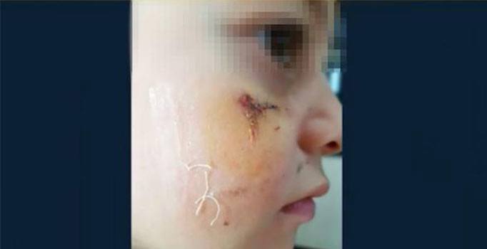 İstanbul'da 6 yaşındaki ilkokul öğrencisi öğretmeni tarafından hastanelik edildi