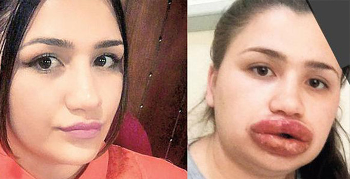 Estetik uzmanı kuaför çıktı: Merve hemşire dudaklarını kaybedebilir