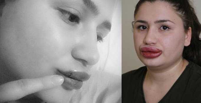 Silikon mağduru hemşire iyileşmeye başlıyor