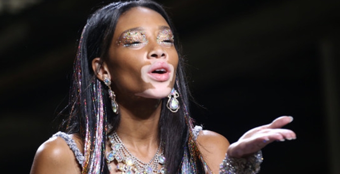 Vitiligo hastası manken Chantelle Brown-Young İstanbul'da